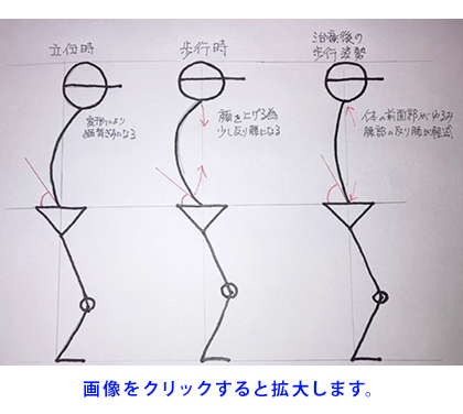 坐骨神経痛