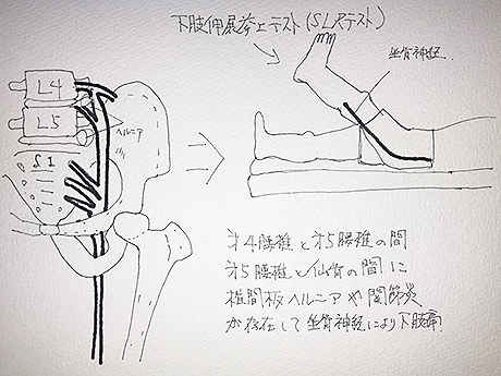 坐骨神経痛・電気鍼