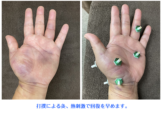 超回復・鍼灸