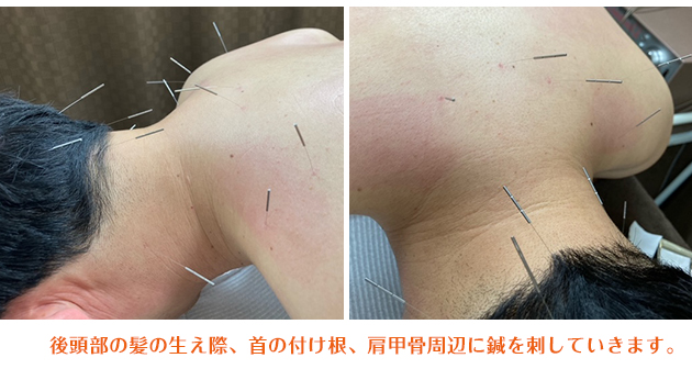 肩こり鍼灸治療イメージ