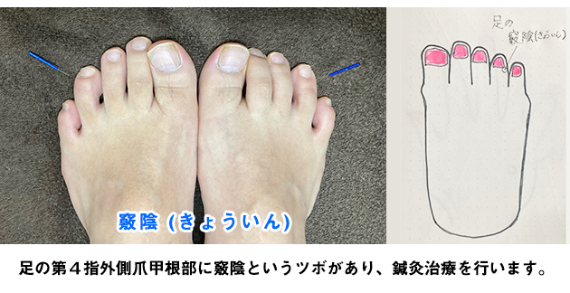 耳鳴り鍼灸治療ツボ