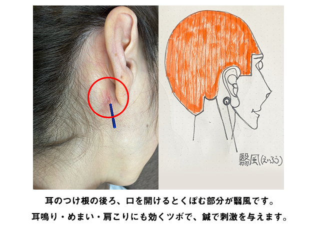 耳鳴り鍼灸治療ツボ