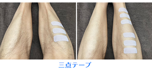 鍼灸のテーピング