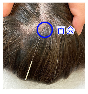 足関節の内側を軽度捻挫