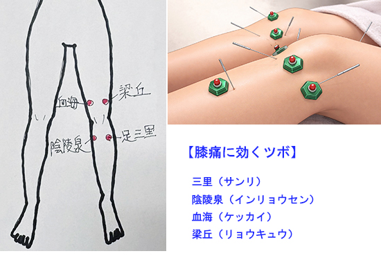 膝の痛みの鍼灸治療