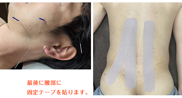 腰痛治療